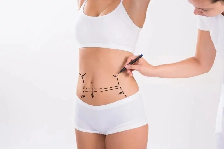 Liposucción: moldeando el cuerpo