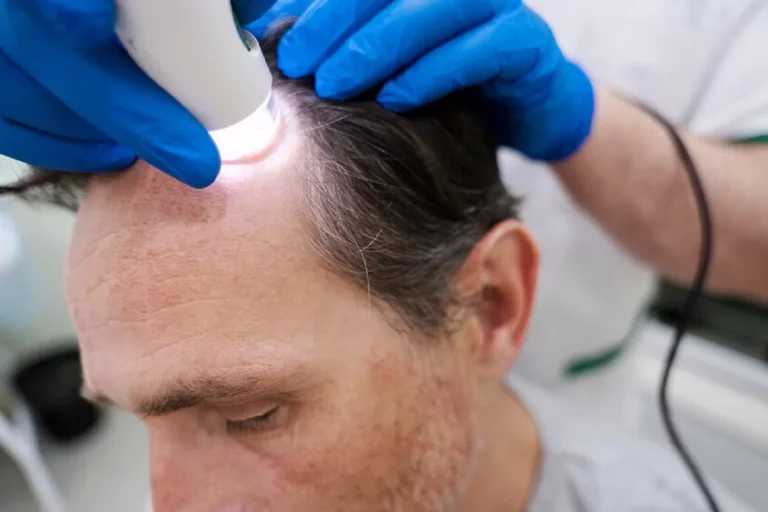 Por qué cada vez más hombres y mujeres en Bilbao recurren a la mesoterapia capilar para fortalecer su pelo