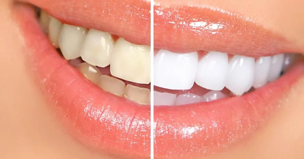 Los Peligros De Pintar Los Dientes Con Esmalte De Uñas