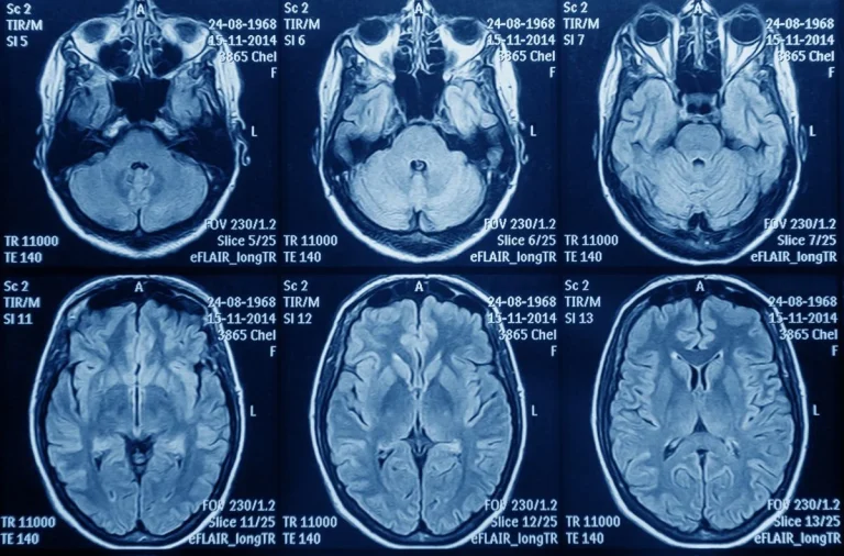 Astuce denuncia que pacientes con glioblastoma «luchan contrarreloj por recibir un tratamiento que prolongaría su supervivencia»