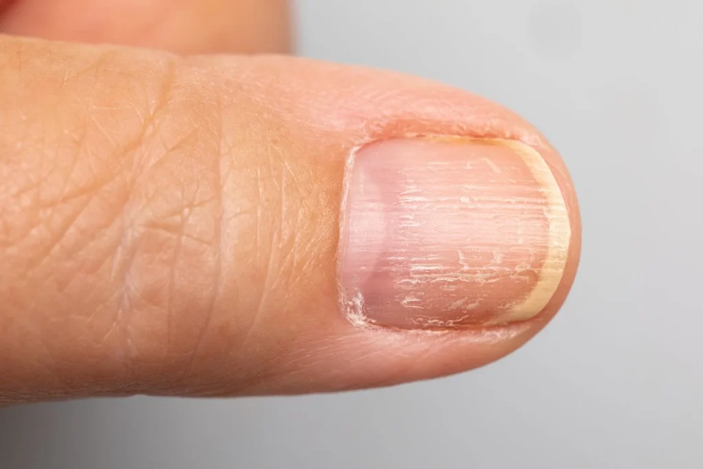 Dry Damaged Yellow Finger Nail Macro View