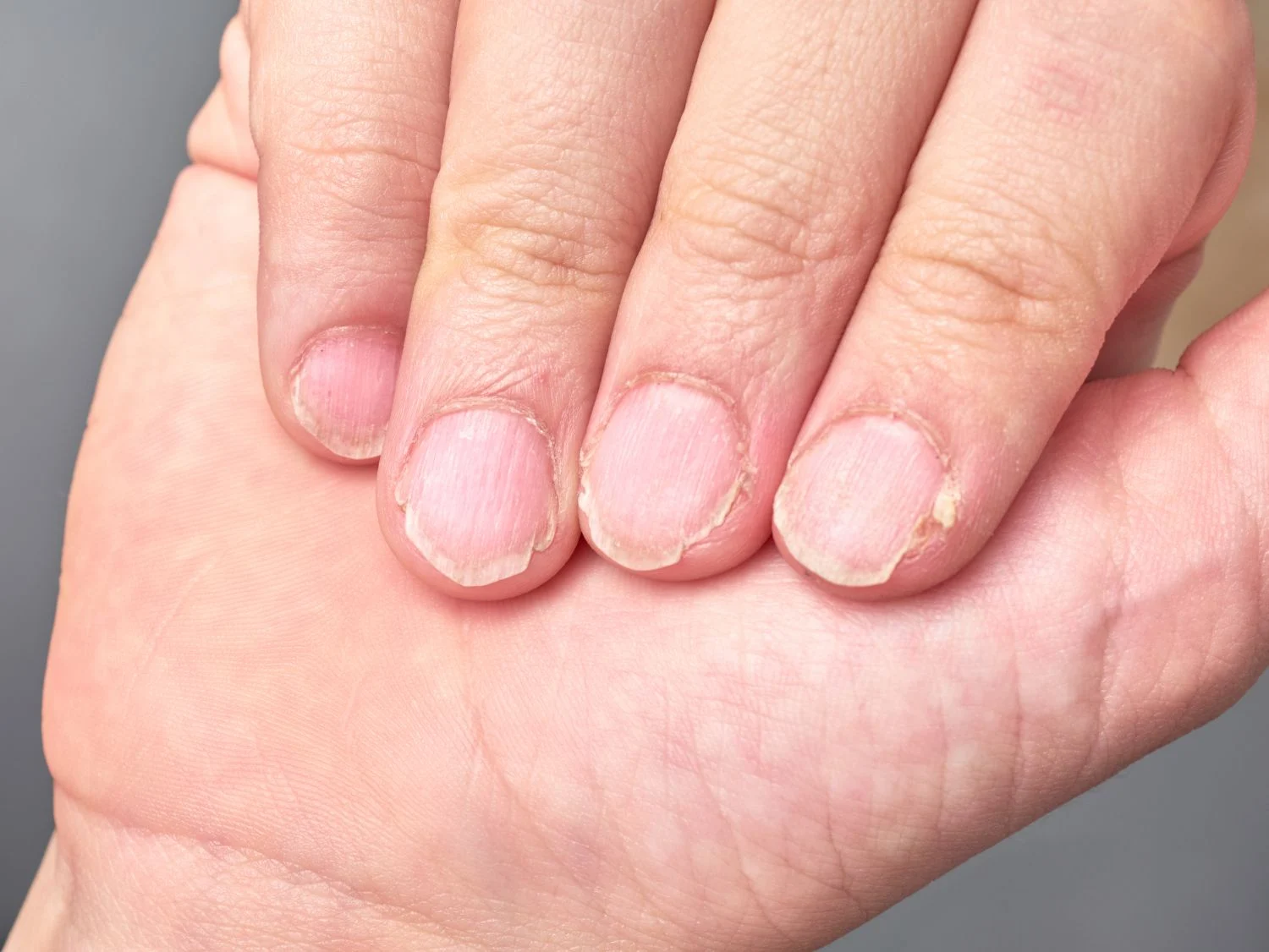 Las Uñas Como Reflejo De La Salud Interna
