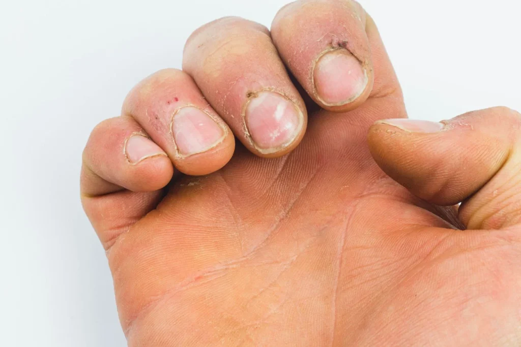 Las Uñas Como Espejo De Nuestra Salud Interna