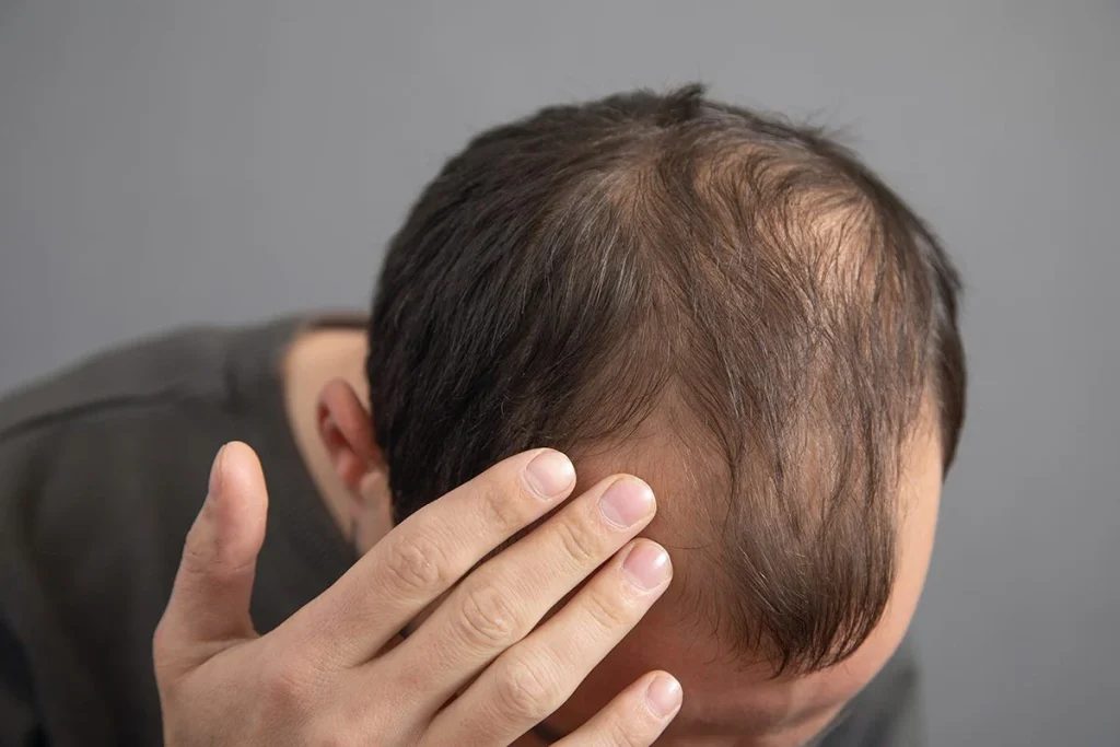 Golpe A La Alopecia