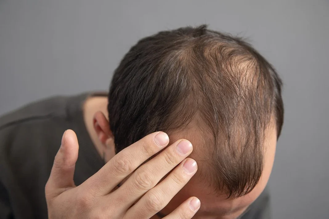 GOLPE A LA ALOPECIA