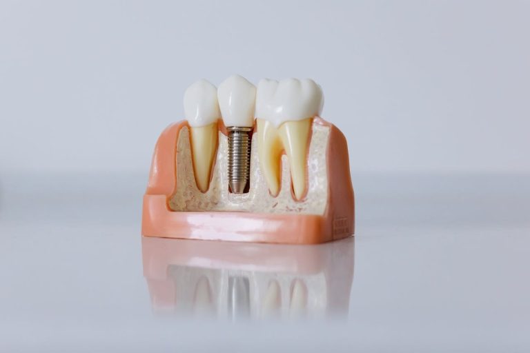 Implantes dentales sin miedo: guía práctica para recuperar tu sonrisa