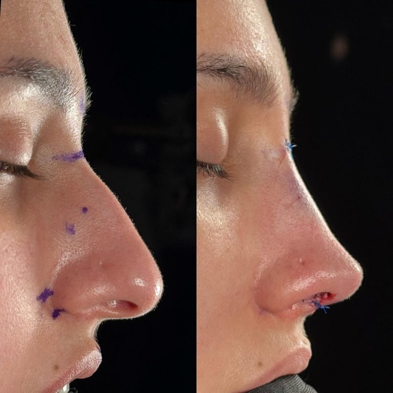 Rinoplastia ultrasónica: la técnica que revoluciona la cirugía nasal