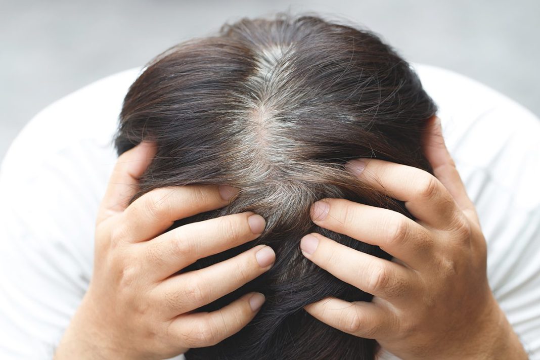LA ALOPECIA ES UNA PATOLOGÍA QUE SUFREN MILLONES DE PERSONAS